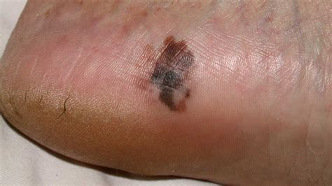 melanoma black spot on bottom of foot